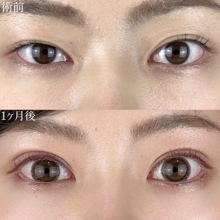 二重埋没法(担当医:TCB 医師)の症例写真2
