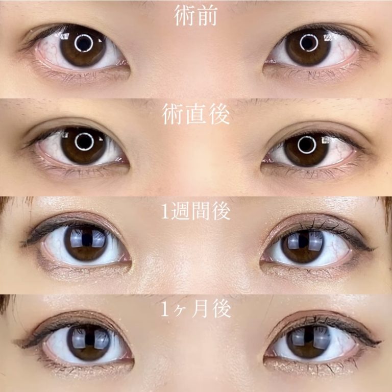 二重埋没法(担当医:TCB 医師)の症例写真3