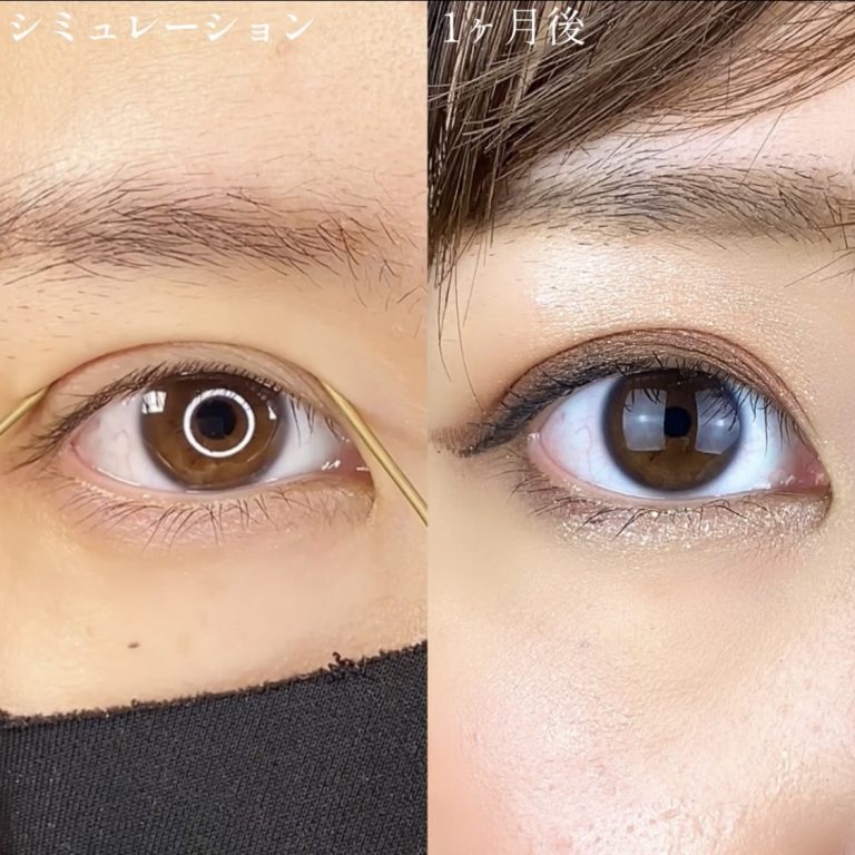 二重埋没法(担当医:TCB 医師)の症例写真2