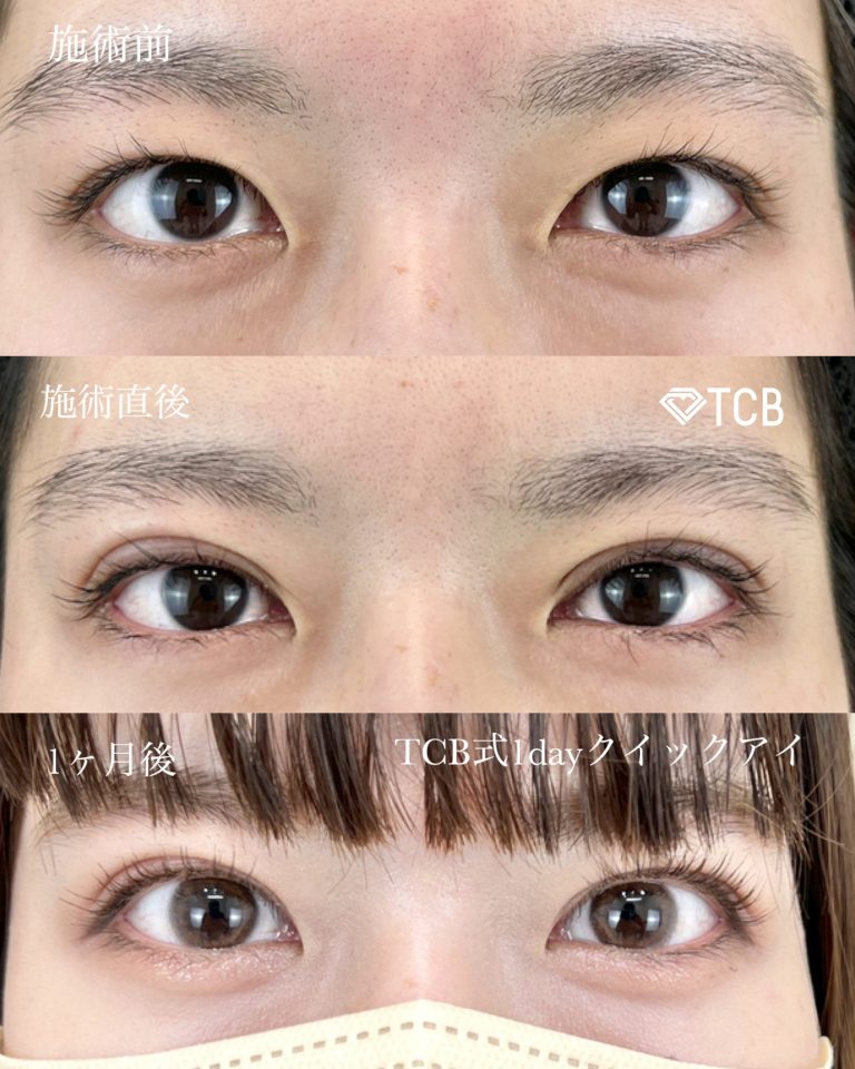 二重埋没法(担当医:寺西 宏王 医師)の症例写真1