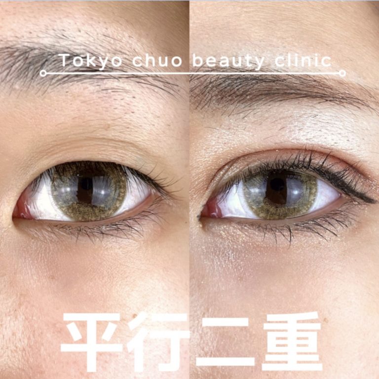 二重埋没法(担当医:TCB 医師)の症例写真1