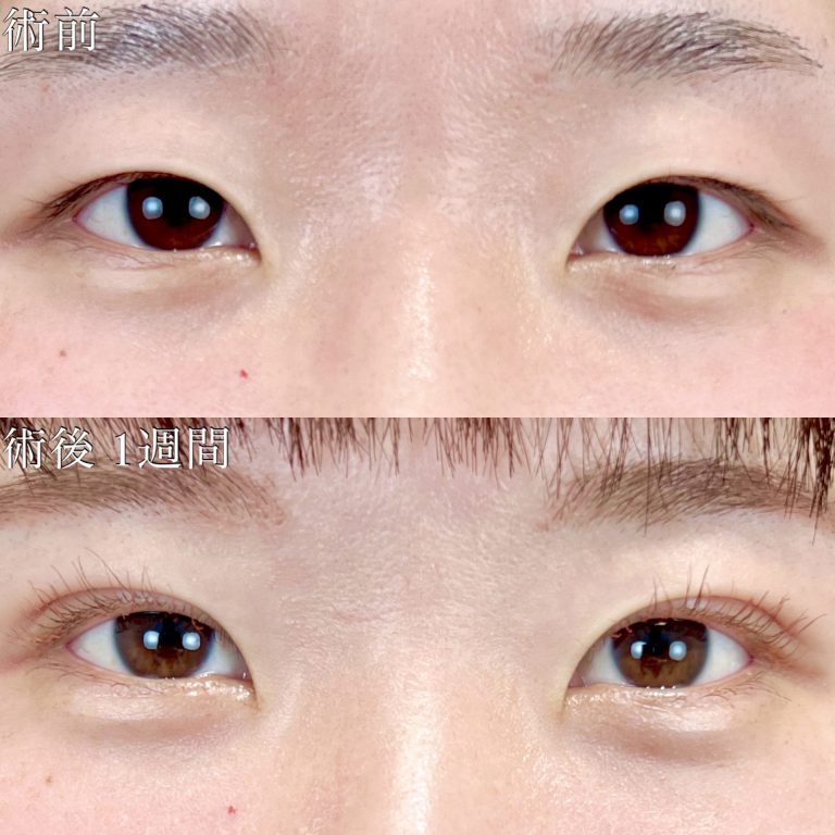 二重埋没法(担当医:TCB 医師)の症例写真1
