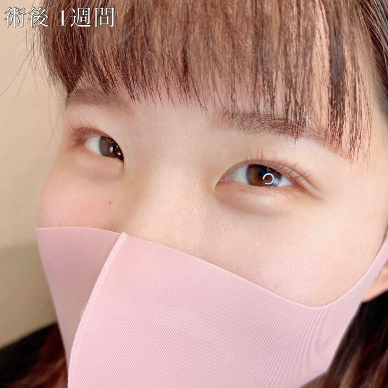二重埋没法(担当医:TCB 医師)の症例写真2