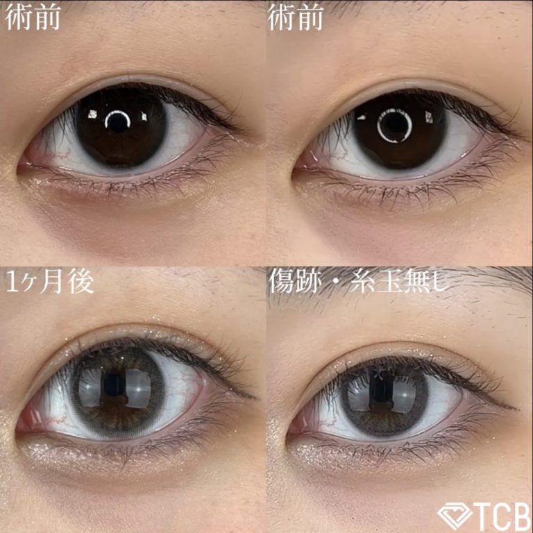 二重埋没法(担当医:TCB 医師)の症例写真1