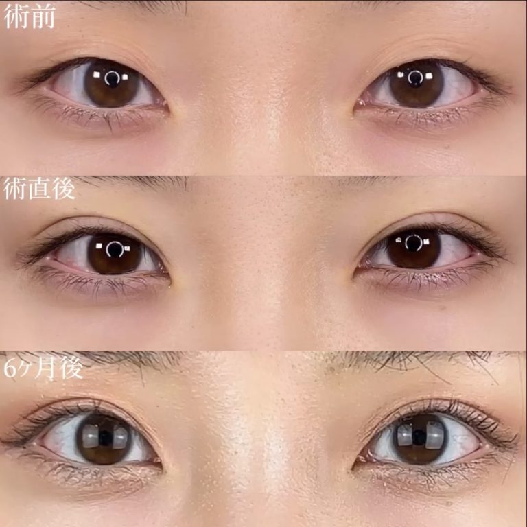 二重埋没法(担当医:TCB 医師)の症例写真2