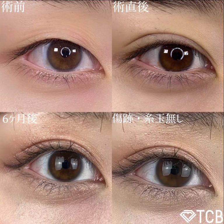 二重埋没法(担当医:TCB 医師)の症例写真1