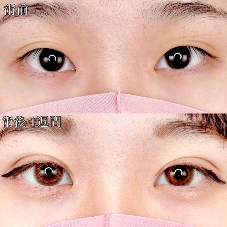 二重埋没法(担当医:TCB 医師)の症例写真1