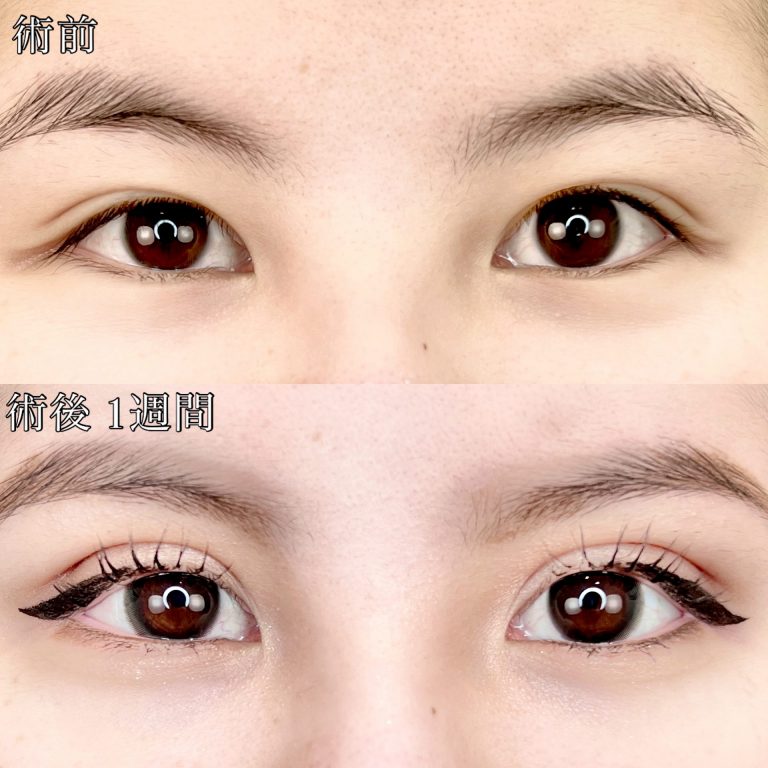二重埋没法(担当医:TCB 医師)の症例写真1