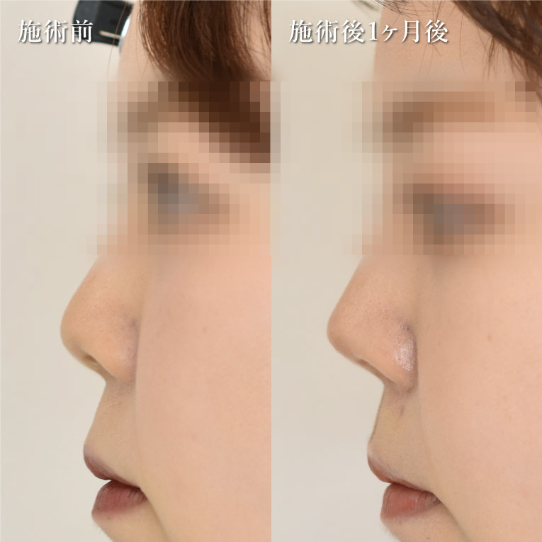 TCB式鼻翼縮小完全内側法(担当医:TCB 医師)の症例写真2