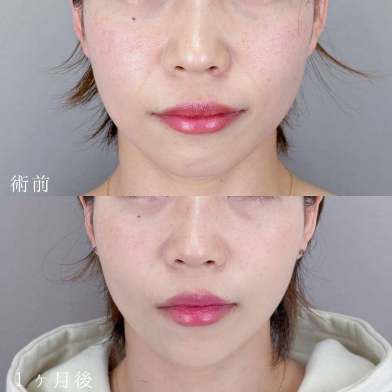 小顔美肌再生（リフトアップ）(担当医:TCB 医師)の症例写真1