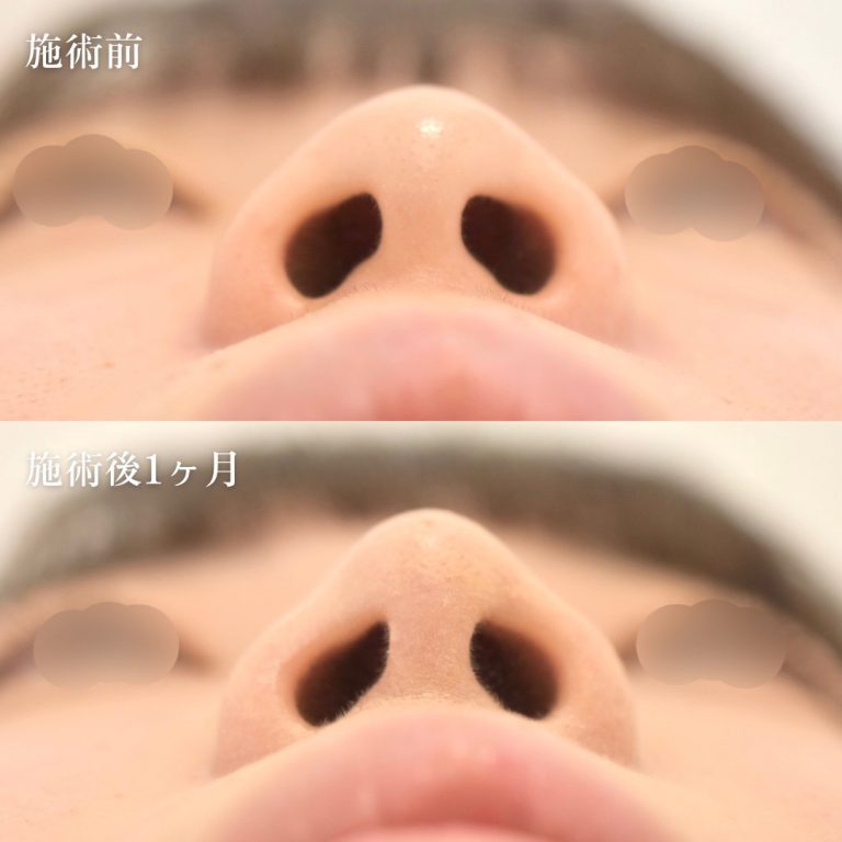 鼻尖形成(担当医:TCB 医師)の症例写真2