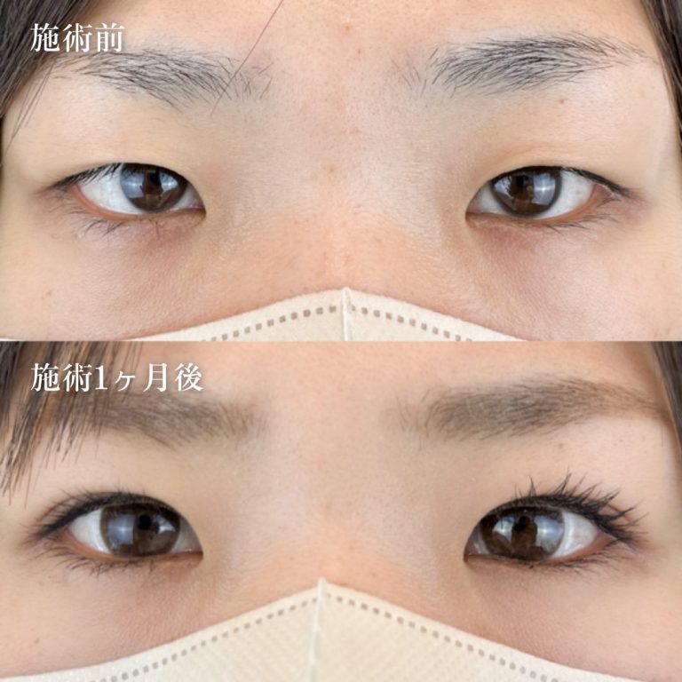 二重埋没法(担当医:林 一樹 医師)の症例写真1