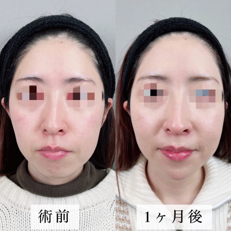 TCB式小顔美肌再生(担当医:佐藤 光 医師)の症例写真1