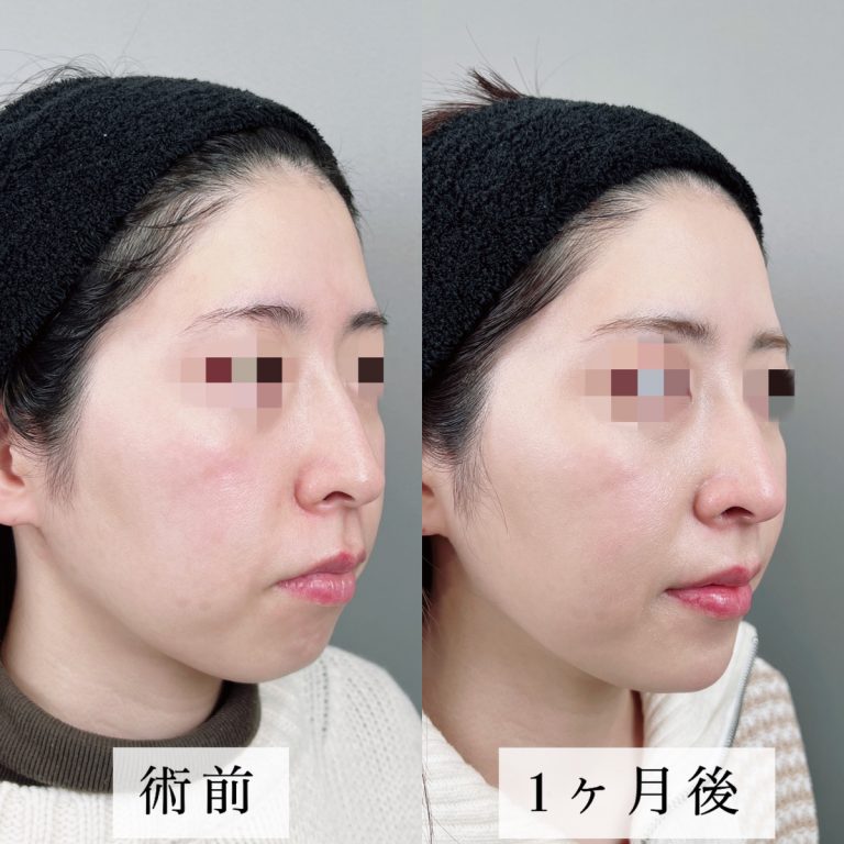 TCB式小顔美肌再生(担当医:佐藤 光 医師)の症例写真2