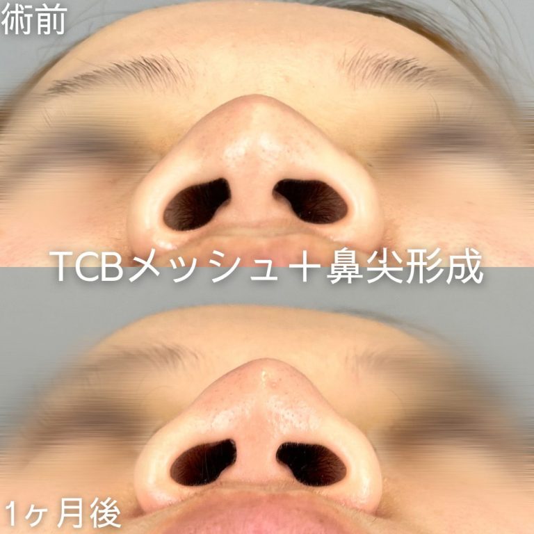 鼻尖形成(担当医:山内 崇史 医師)の症例写真3