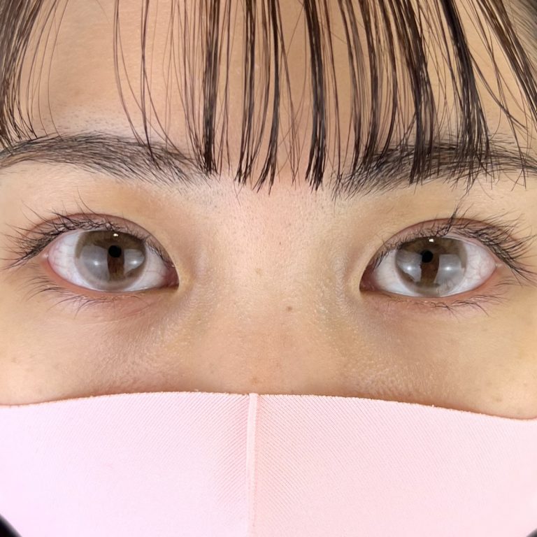 二重埋没法(担当医:TCB 医師)の症例写真2