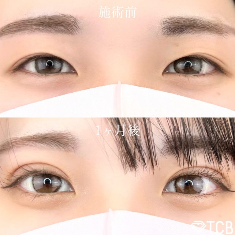 二重埋没法(担当医:TCB 医師)の症例写真1