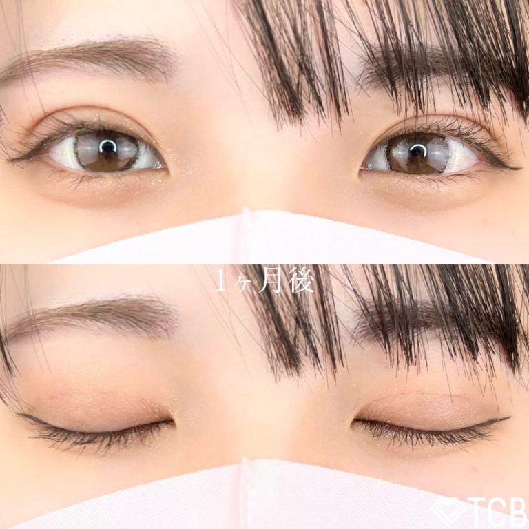 二重埋没法(担当医:TCB 医師)の症例写真2