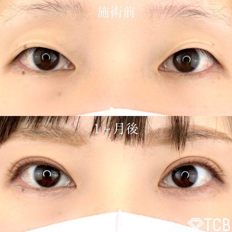 二重埋没法(担当医:TCB 医師)の症例写真1