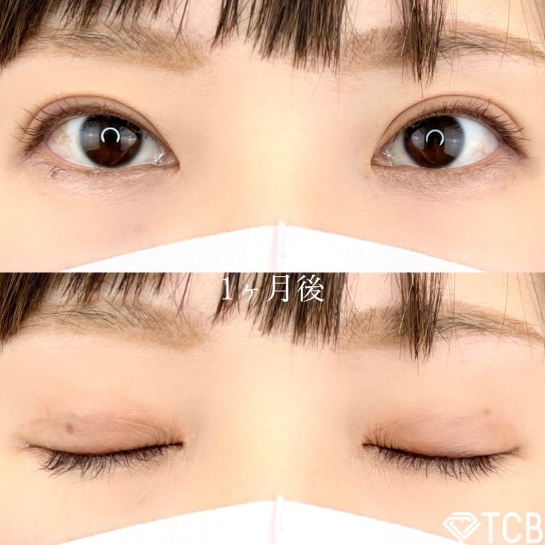 二重埋没法(担当医:TCB 医師)の症例写真2