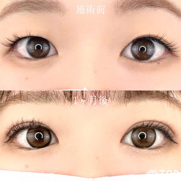 二重埋没法(担当医:TCB 医師)の症例写真1