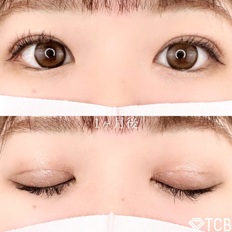 二重埋没法(担当医:TCB 医師)の症例写真2