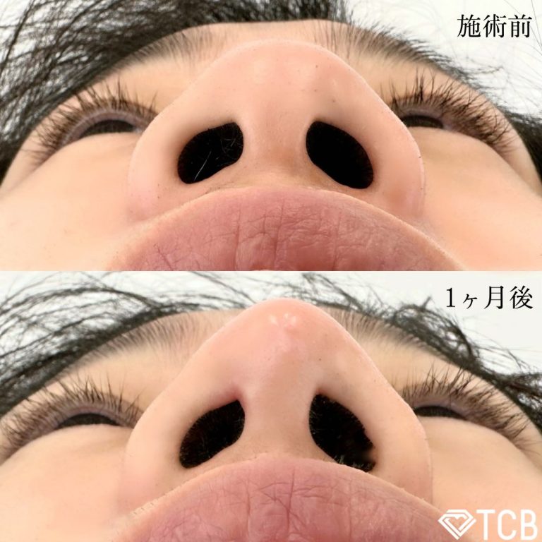 TCB式鼻先尖鋭術（だんご鼻解消）(担当医:TCB 医師)の症例写真1