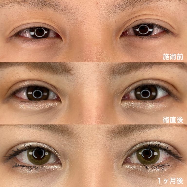二重埋没法(担当医:TCB 医師)の症例写真1