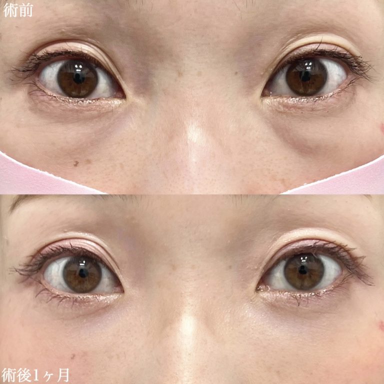 切らない目の下のクマ取り・目の下のたるみ（ふくらみ）取り(担当医:TCB 医師)の症例写真1