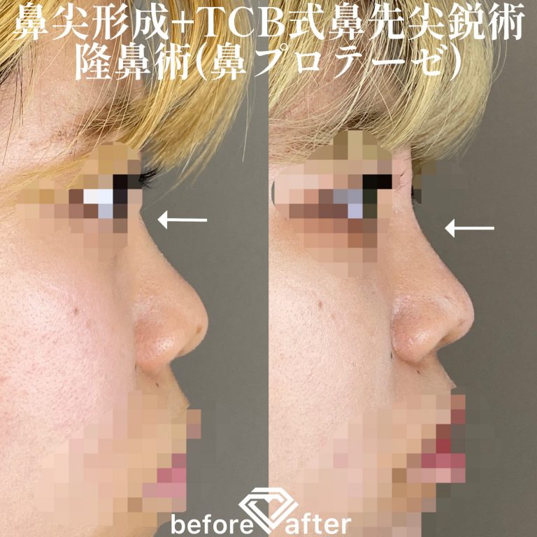 鼻プロテーゼ（隆鼻術）(担当医:森本 理一郎 医師)の症例写真3