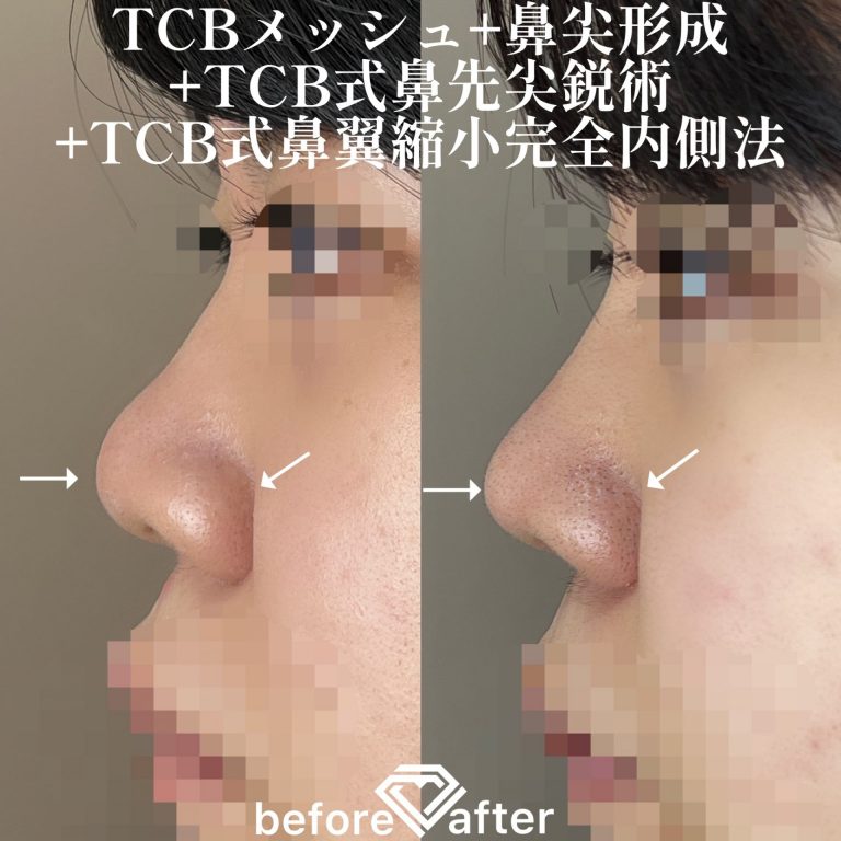 TCB式鼻先尖鋭術（だんご鼻解消）(担当医:TCB 医師)の症例写真2