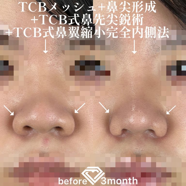 TCB式鼻先尖鋭術（だんご鼻解消）(担当医:TCB 医師)の症例写真4