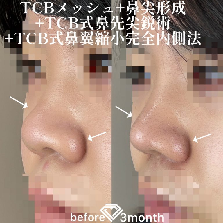 TCB式鼻先尖鋭術（だんご鼻解消）(担当医:TCB 医師)の症例写真1