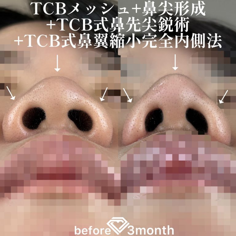 TCB式鼻先尖鋭術（だんご鼻解消）(担当医:TCB 医師)の症例写真3