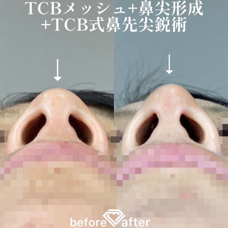 鼻尖形成(担当医:森本 理一郎 医師)の症例写真1