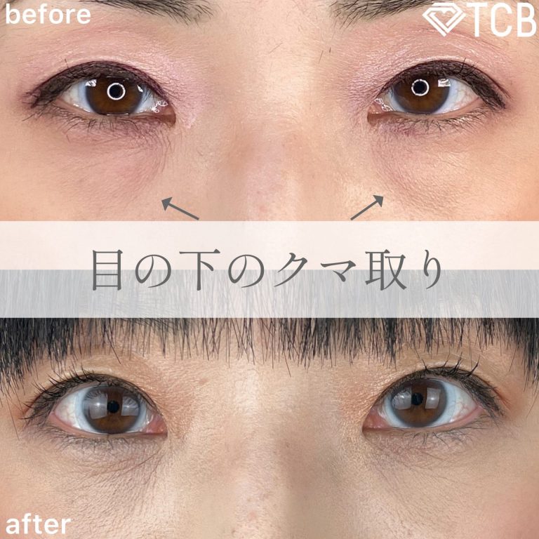 切らない目の下のクマ取り・目の下のたるみ（ふくらみ）取り(担当医:TCB 医師)の症例写真1