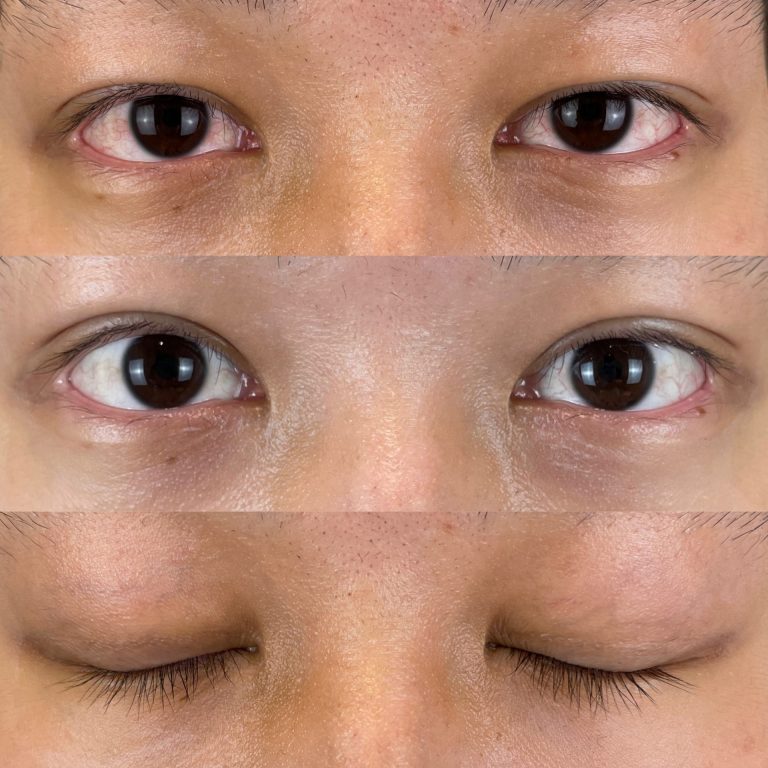 二重埋没法(担当医:TCB 医師)の症例写真1