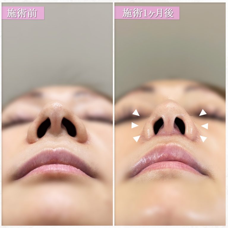 TCB式鼻翼縮小完全内側法(担当医:篠永 宏行 医師)の症例写真1