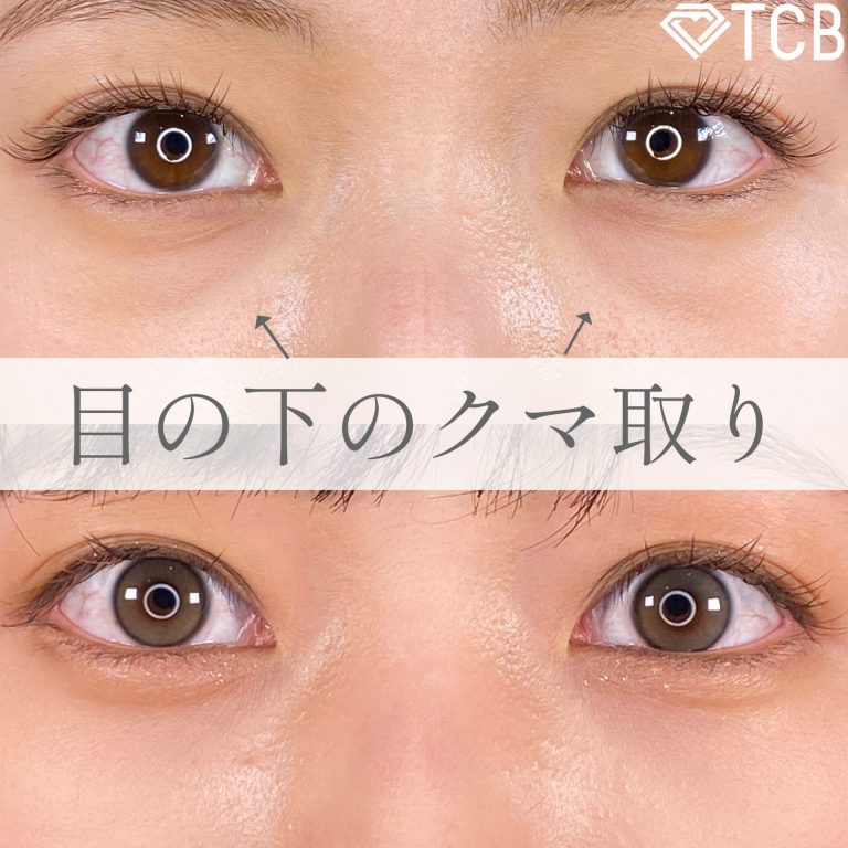 切らない目の下のクマ取り・目の下のたるみ（ふくらみ）取り(担当医:TCB 医師)の症例写真1