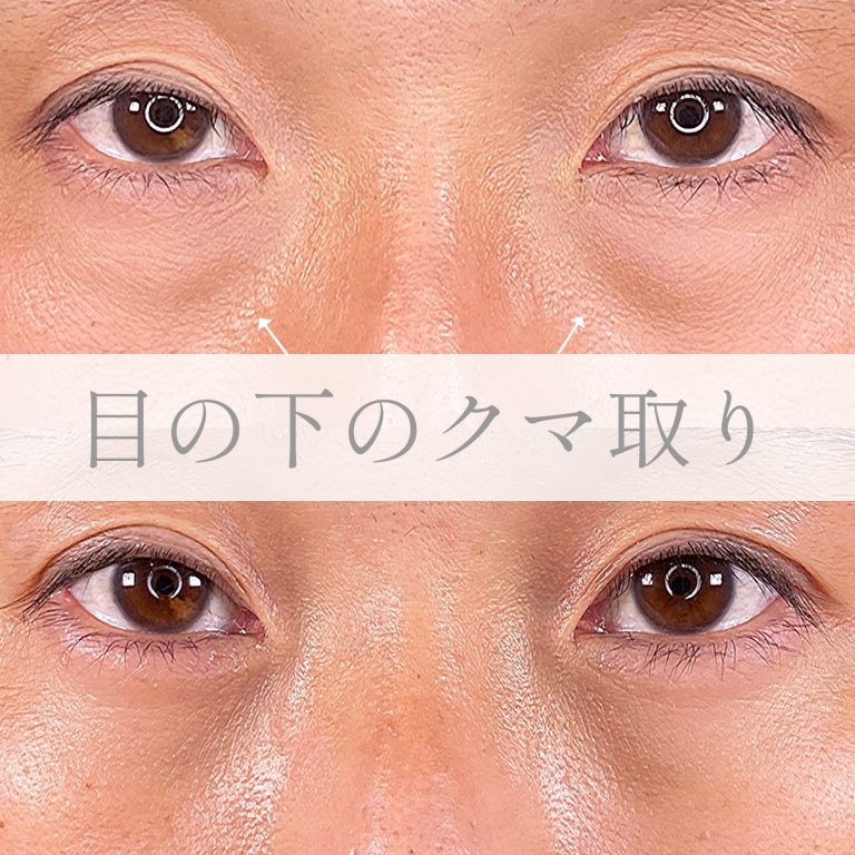 切らない目の下のクマ取り・目の下のたるみ（ふくらみ）取り(担当医:TCB 医師)の症例写真1