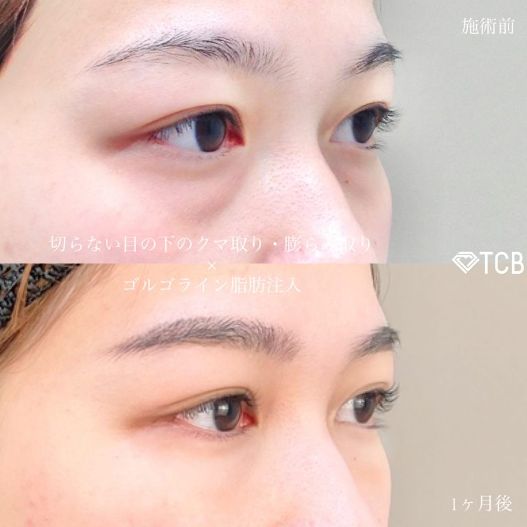 切らない目の下のクマ取り・目の下のたるみ（ふくらみ）取り(担当医:TCB 医師)の症例写真3