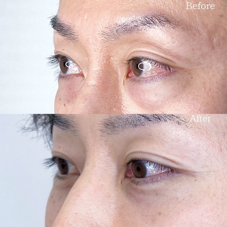 切らない目の下のクマ取り・目の下のたるみ（ふくらみ）取り(担当医:TCB 医師)の症例写真1