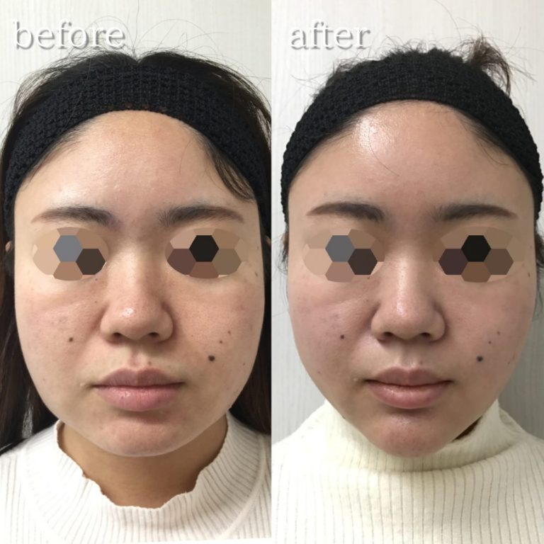 小顔美肌再生（リフトアップ）(担当医:TCB 医師)の症例写真1