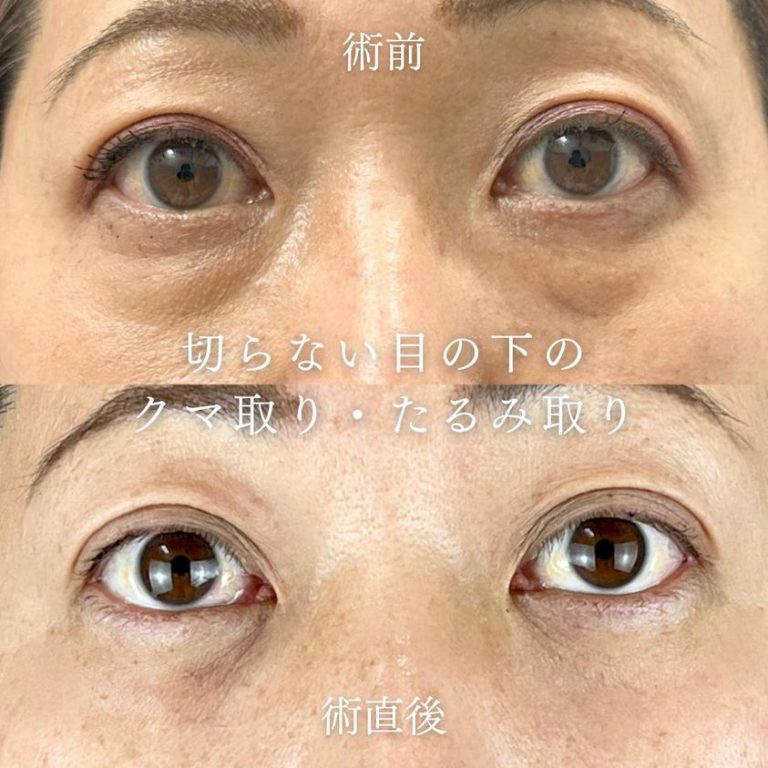 切らない目の下のクマ取り・目の下のたるみ（ふくらみ）取り(担当医:TCB 医師)の症例写真1