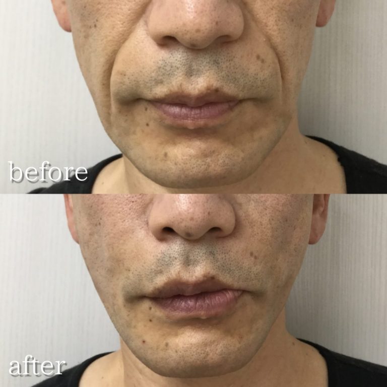 小顔美肌再生（リフトアップ）(担当医:TCB 医師)の症例写真1