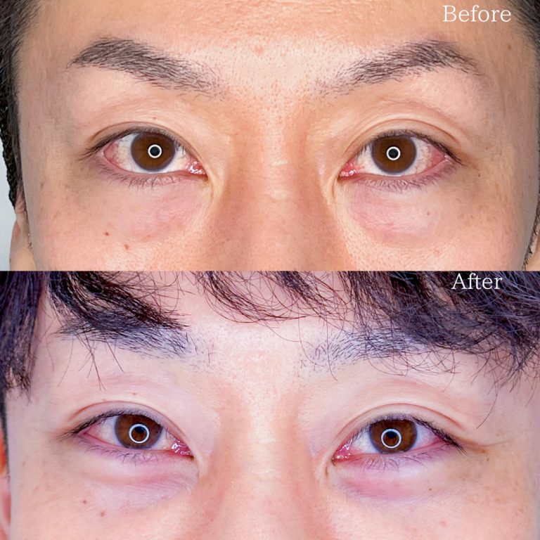 切らない目の下のクマ取り・目の下のたるみ（ふくらみ）取り(担当医:TCB 医師)の症例写真2