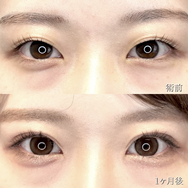 二重埋没法(担当医:TCB 医師)の症例写真1