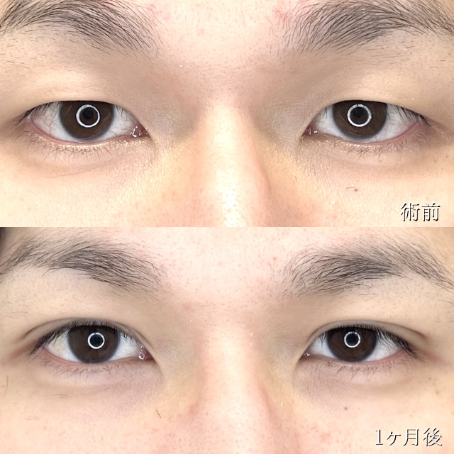 二重埋没法(担当医:TCB 医師)の症例写真1