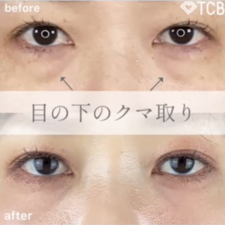 切らない目の下のクマ取り・目の下のたるみ（ふくらみ）取り(担当医:TCB 医師)の症例写真1