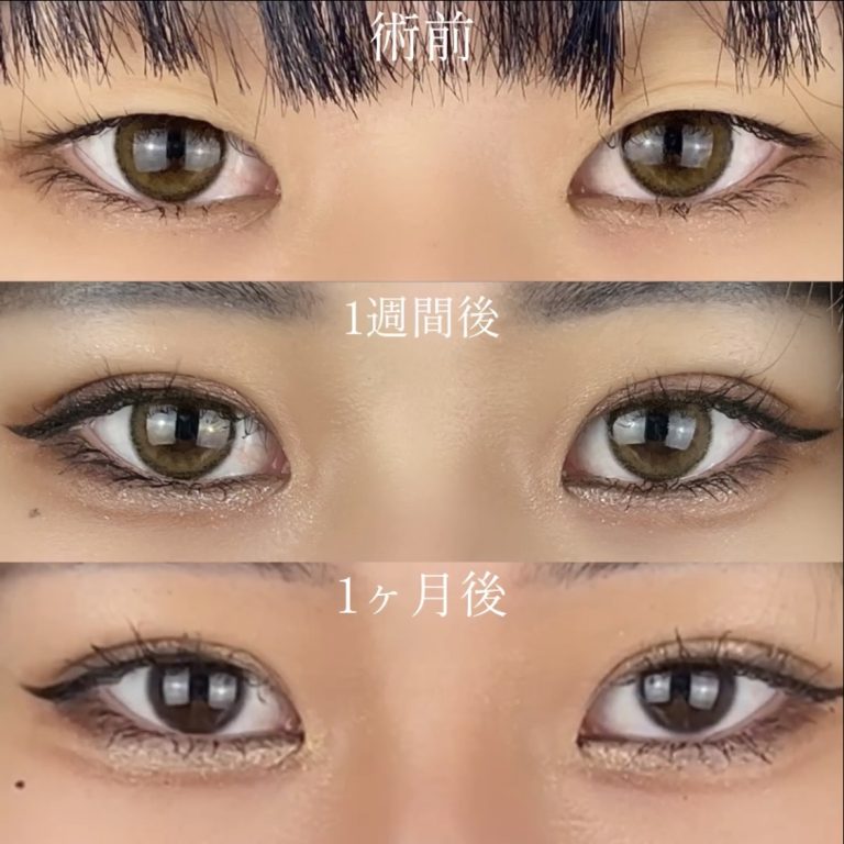 二重埋没法(担当医:TCB 医師)の症例写真2